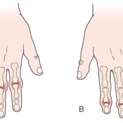 osteopatia noduli artrosi