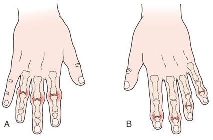 osteopatia noduli artrosi