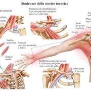 sindrome dello stretto toracico 1024x642