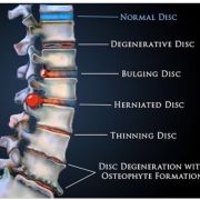 ernia e osteopatia