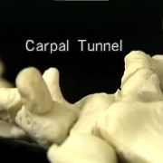 tunnel carpale osteopatia