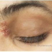 Herpes zoster osteopata segrate