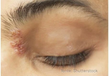 Herpes zoster osteopata segrate
