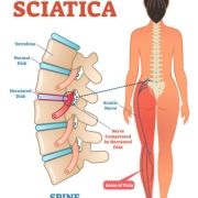 Sciatica osteopata milano