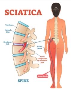 Sciatica: può essere utile l’osteopatia?