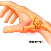 Rizoartrosi osteopata milano