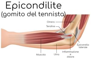 Dolore al gomito: epicondilite ed osteopatia