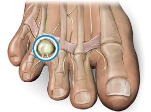 Neuroma di Morton: può l’osteopatia essere utile?