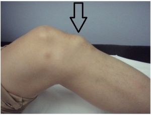 Osgood-schlatter: dolore e gonfiore all'epifisi tibiale