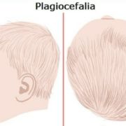 Plagiocefalia osteopata milano