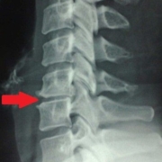 Schiacciamento vertebrale osteopata milano