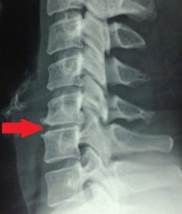 Vertebre schiacciate: il ruolo dell’osteopata